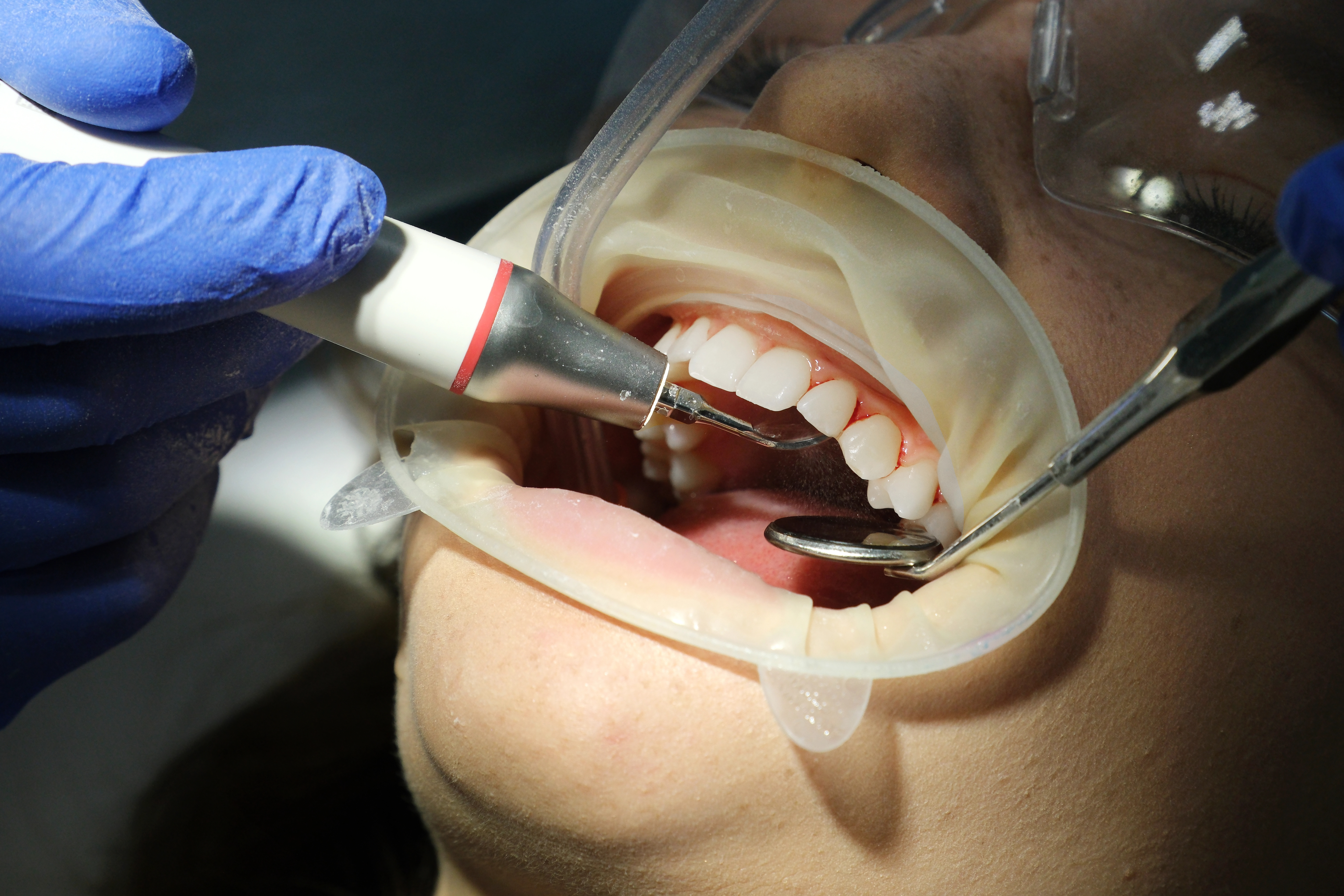 painful dentures Patient unaware of intraoral scan data being shared